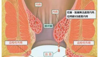 肛门扩大失禁的经历-肛门扩大失禁，从痛苦到重获自信