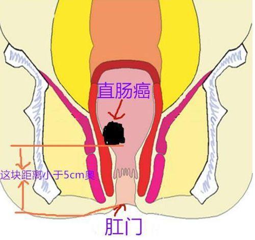 肛门粘液失禁怎么办_肛门粘液失禁怎么回事_肛门失禁 粘液