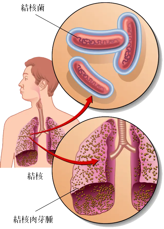 肺结核的型状_三型肺结核的症状_肺症状结核型是什么