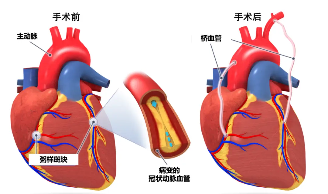 冠心病诊断与治疗指南发表_从指南看冠心病的治疗进展_冠心病诊疗指南