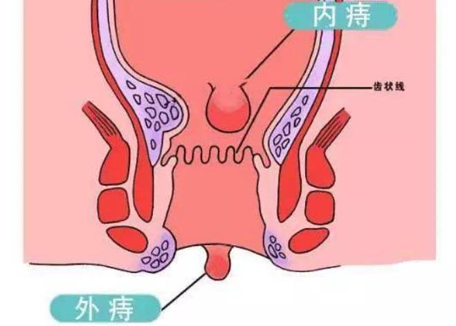 肛门失禁的案例_肛门失禁定义_肛门失禁诊断标准