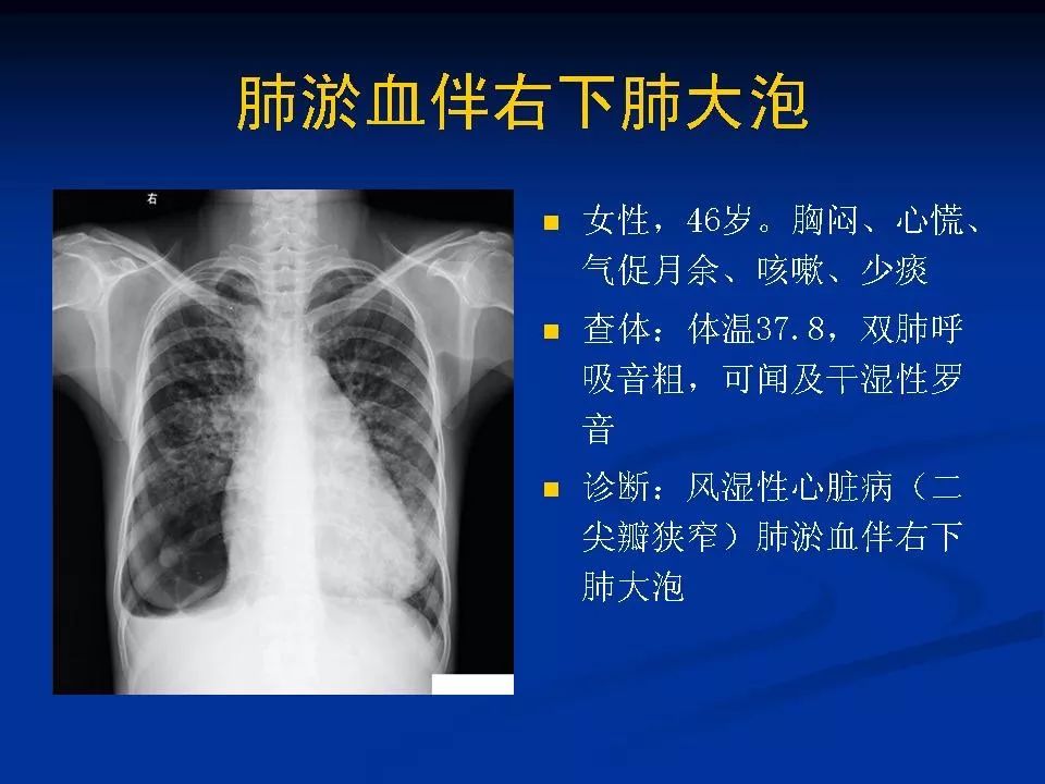 肺炎白痰好还是黄痰好_肺炎+白痰_白痰肺炎