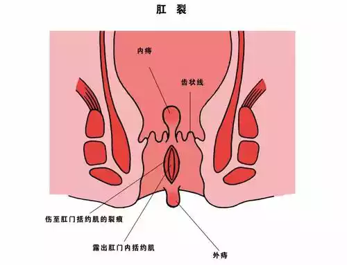 肛门括约肌失禁_肛门括约肌失禁的鉴别诊断_肛门括约肌失禁怎么办